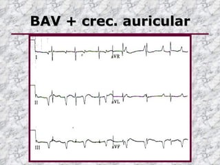 BAV + crec. auricular
 