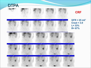 DTPADTPA
GFR = 25 ml/’
Creat = 3.0
L= 33%
R= 67%
CRF
 