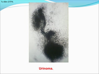 Tc-99m DTPA
Urinoma.
 