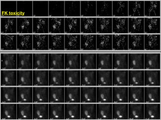 FK toxicity
 