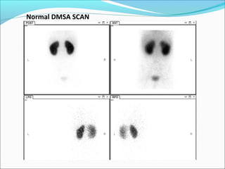 Normal DMSA SCAN
 