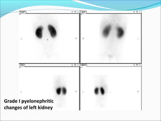 Grade I pyelonephritic
changes of left kidney
 