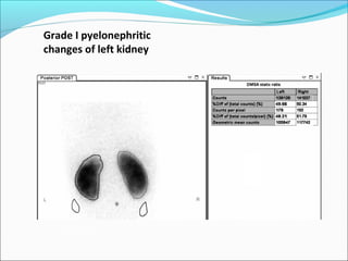 Grade I pyelonephritic
changes of left kidney
 