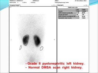 - Grade II pyelonephritic left kidney.
- Normal DMSA scan right kidney.
 