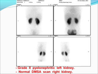 - Grade II pyelonephritic left kidney.
- Normal DMSA scan right kidney.
 