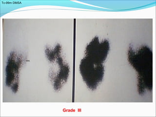 Tc-99m DMSA
Ant. Post.
Grade III
 