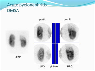 post L
LPO pinhole
post R
RPO
LEAP
 
