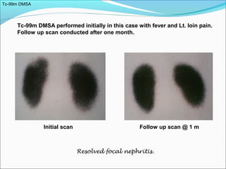 Tc-99m DMSA performed initially in this case with fever and Lt. loin pain.
Follow up scan conducted after one month.
Initial scan Follow up scan @ 1 m
Resolved focal nephritis.
Tc-99m DMSA
 