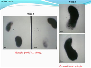 Tc-99m DMSA
Ant. Post.
Ant.
Post.
Case 1
Case 2
Ectopic “pelvic” Lt. kidney.
Crossed fused ectopia.
 