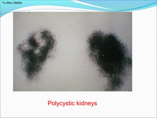 Tc-99m DMSA
Polycystic kidneys
 