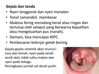Gejala dan tanda
• Nyeri tenggorok dan nyeri menelan
• Tonsil (amandel) membesar
• Mukosa faring meradang berat atau ringan dan
tertutup oleh selaput yang berwarna keputihan
atau mengeluarkan pus (nanah).
• Demam, bisa mencapai 40ºC.
• Pembesaran kelenjar getah bening
Gejala-gejala sistemik akan muncul :
Lesu dan lemah, nyeri pada sendi-
sendi otot, tidak nafsu makan dan
nyeri pada telinga.
Peningkatan jumlah sel darah putih.
 