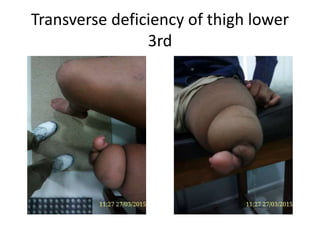 Transverse deficiency of thigh lower
3rd
 