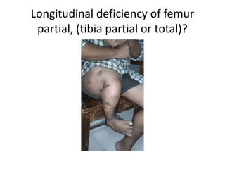 Longitudinal deficiency of femur
partial, (tibia partial or total)?
 