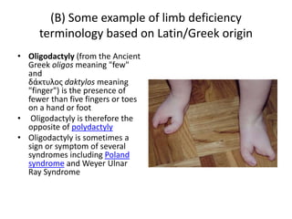 (B) Some example of limb deficiency
terminology based on Latin/Greek origin
• Oligodactyly (from the Ancient
Greek oligos meaning "few"
and
δάκτυλος daktylos meaning
"finger") is the presence of
fewer than five fingers or toes
on a hand or foot
• Oligodactyly is therefore the
opposite of polydactyly
• Oligodactyly is sometimes a
sign or symptom of several
syndromes including Poland
syndrome and Weyer Ulnar
Ray Syndrome
 