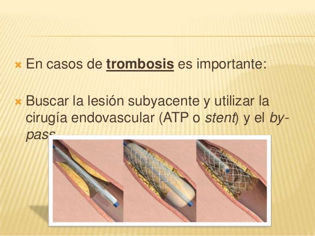 El tratamiento eficaz de la várice varicosa en los pies
