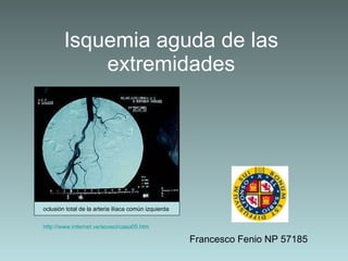 Isquemia aguda de las extremidades Francesco Fenio NP 57185 oclusión total de la arteria ilíaca común izquierda  http://www.internet.ve/ soveci /caso05.htm   