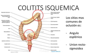 COLITITS ISQUEMICA
Los sitios mas
comunes de
oclusión es:
- Angulo
esplénico
- Union rectosigmoidea

 