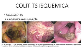 COLITITS ISQUEMICA
• ENDOSCOPIA
es la técnica mas sensible

 