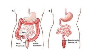Isquemia intestinal