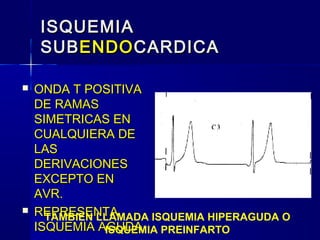 ISQUEMIAISQUEMIA
SUBSUBENDOENDOCARDICACARDICA
 ONDA T POSITIVAONDA T POSITIVA
DE RAMASDE RAMAS
SIMETRICAS ENSIMETRICAS EN
CUALQUIERA DECUALQUIERA DE
LASLAS
DERIVACIONESDERIVACIONES
EXCEPTO ENEXCEPTO EN
AVR.AVR.
 REPRESENTAREPRESENTA
ISQUEMIA AGUDAISQUEMIA AGUDA
TAMBIEN LLAMADA ISQUEMIA HIPERAGUDA O
ISQUEMIA PREINFARTO
 