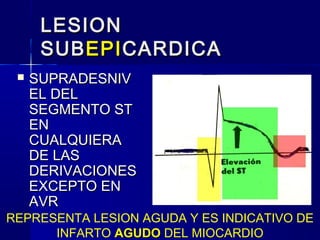 LESIONLESION
SUBSUBEPIEPICARDICACARDICA
 SUPRADESNIVSUPRADESNIV
EL DELEL DEL
SEGMENTO STSEGMENTO ST
ENEN
CUALQUIERACUALQUIERA
DE LASDE LAS
DERIVACIONESDERIVACIONES
EXCEPTO ENEXCEPTO EN
AVRAVR
REPRESENTA LESION AGUDA Y ES INDICATIVO DE
INFARTO AGUDOAGUDO DEL MIOCARDIO
 