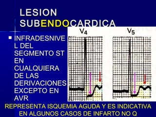 LESIONLESION
SUBSUBENDOENDOCARDICACARDICA
 INFRADESNIVEINFRADESNIVE
L DELL DEL
SEGMENTO STSEGMENTO ST
ENEN
CUALQUIERACUALQUIERA
DE LASDE LAS
DERIVACIONESDERIVACIONES
EXCEPTO ENEXCEPTO EN
AVRAVR
REPRESENTA ISQUEMIA AGUDA Y ES INDICATIVA
EN ALGUNOS CASOS DE INFARTO NO Q
 