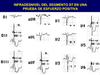 INFRADESNIVEL DEL SEGMENTO ST EN UNA
PRUEBA DE ESFUERZO POSITIVA
 
