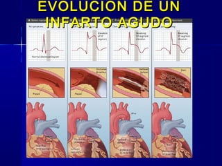EVOLUCION DE UNEVOLUCION DE UN
INFARTO AGUDOINFARTO AGUDO
 