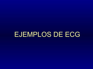 EJEMPLOS DE ECG
 