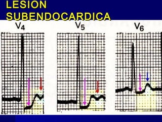 LESIONLESION
SUBENDOCARDICASUBENDOCARDICA
 