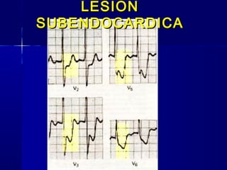 LESIONLESION
SUBENDOCARDICASUBENDOCARDICA
 