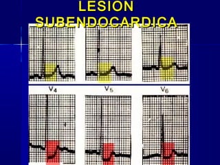 LESIONLESION
SUBENDOCARDICASUBENDOCARDICA
 