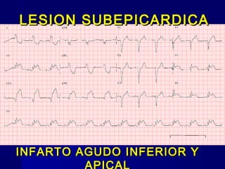 LESION SUBEPICARDICALESION SUBEPICARDICA
INFARTO AGUDO INFERIOR YINFARTO AGUDO INFERIOR Y
 