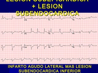 LESION SUBEPICARDICALESION SUBEPICARDICA
+ LESION+ LESION
SUBENDOCARDICASUBENDOCARDICA
INFARTO AGUDO LATERAL MAS LESIONINFARTO AGUDO LATERAL MAS LESION
SUBENDOCARDICA INFERIORSUBENDOCARDICA INFERIOR
 