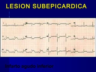 Infarto agudo inferior
LESION SUBEPICARDICALESION SUBEPICARDICA
 