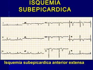 Isquemia subepicardica anterior extensa
ISQUEMIAISQUEMIA
SUBEPICARDICASUBEPICARDICA
 
