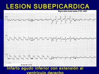 LESION SUBEPICARDICALESION SUBEPICARDICA
Infarto agudo inferior con extensión alInfarto agudo inferior con extensión al
 