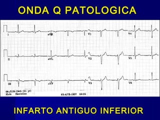 ONDA Q PATOLOGICAONDA Q PATOLOGICA
INFARTO ANTIGUO INFERIORINFARTO ANTIGUO INFERIOR
 