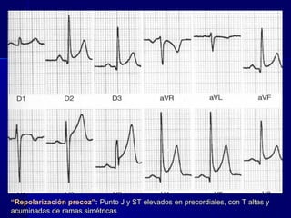 “Repolarización precoz”: Punto J y ST elevados en precordiales, con T altas y
acuminadas de ramas simétricas
 