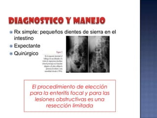 Rx simple: pequeños dientes de sierra en el
intestino
 Expectante
 Quirúrgico


El procedimiento de elección
para la enteritis focal y para las
lesiones obstructivas es una
resección limitada

 