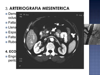 3. ARTERIOGRAFIA MESENTERICA
Demostración de un trombo en la VMS con
oclusión parcial o completa
 Falta de visualización de la VMS o vena porta
 Llenado lento o inexistente de las VM
 Espasmo arterial
 Falta de vaciamiento de los arcos arteriales
 Rubor


4. ECOGRAFIA
 Engrosamiento de pared abdominal y liquido
peritoneal libre = isquemia intestinal

 