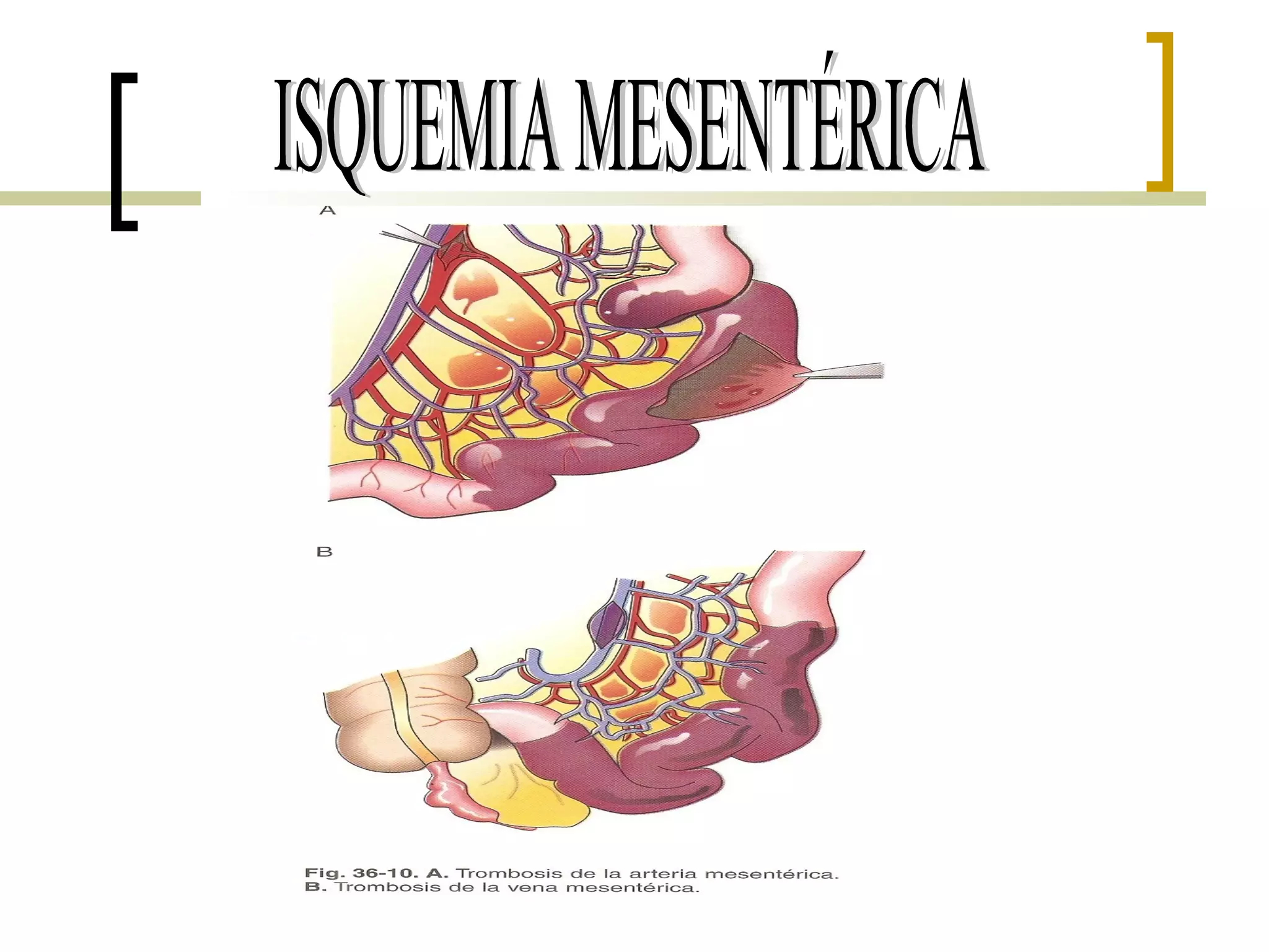 Isquemia mesentérica | PPT