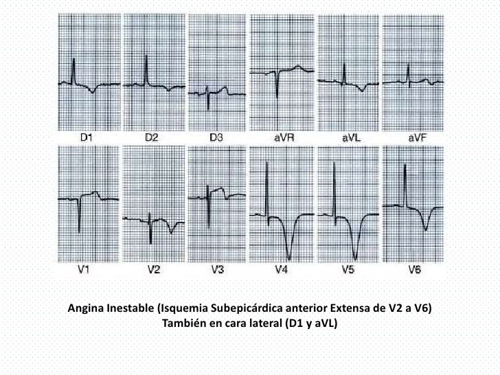 EKG Isquemia