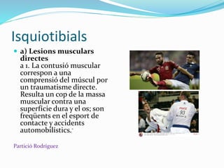 Isquiotibials
 a) Lesions musculars
directes
a 1. La contusió muscular
correspon a una
comprensió del múscul por
un traumatisme directe.
Resulta un cop de la massa
muscular contra una
superfície dura y el os; son
freqüents en el esport de
contacte y accidents
automobilístics.-
Partició Rodríguez
 
