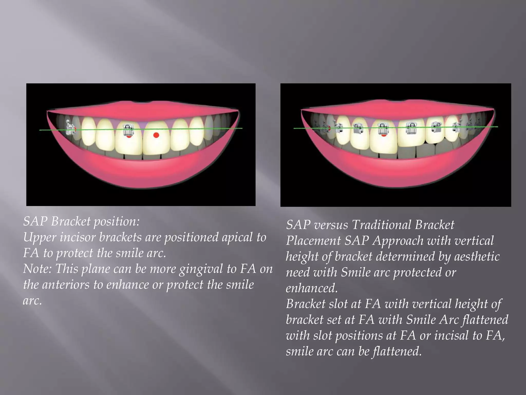bracket positioning for smile arc protection | PPTX