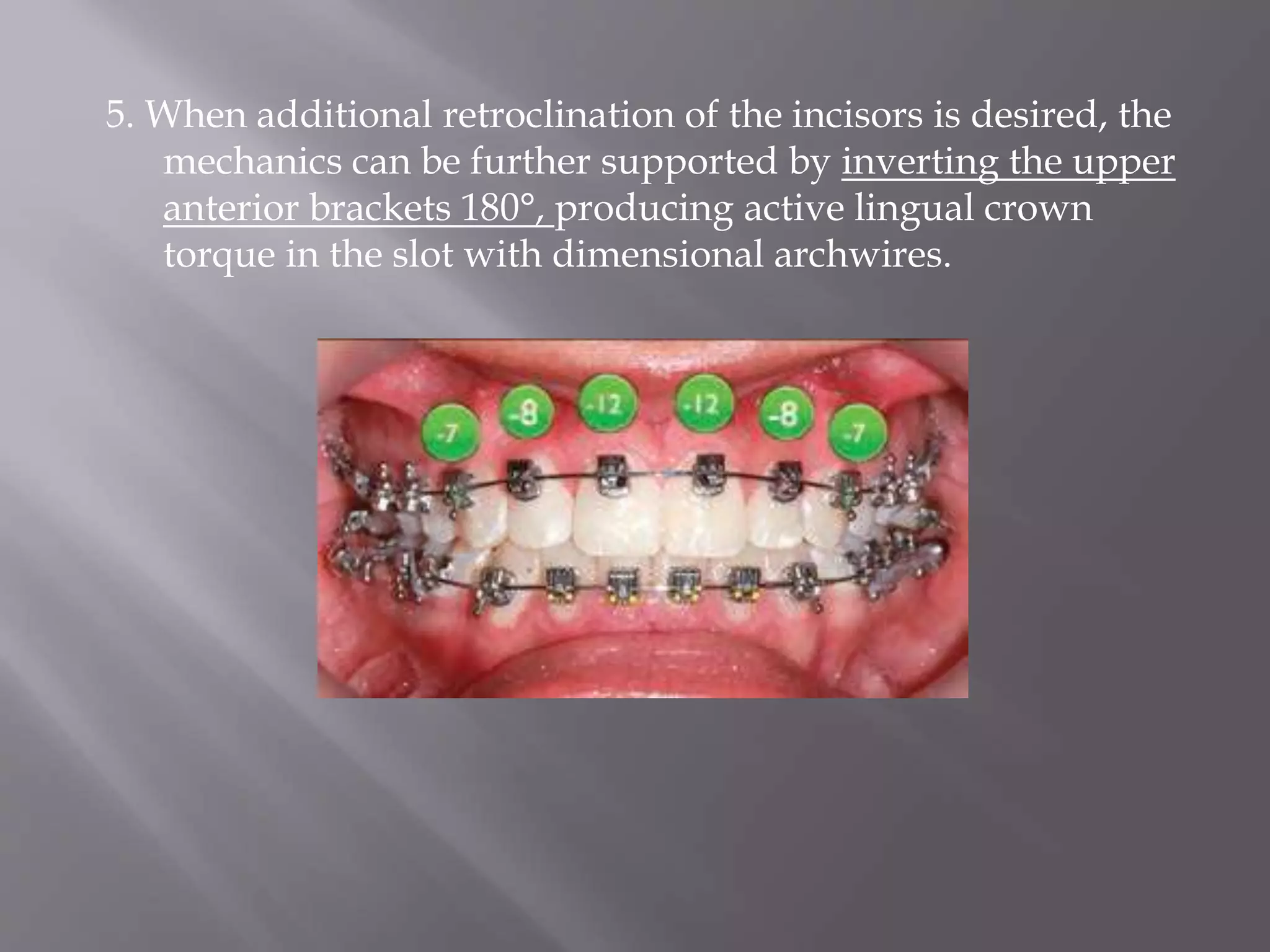 5. When additional retroclination of the incisors is desired, the
mechanics can be further supported by inverting the upper
anterior brackets 180°, producing active lingual crown
torque in the slot with dimensional archwires.
 