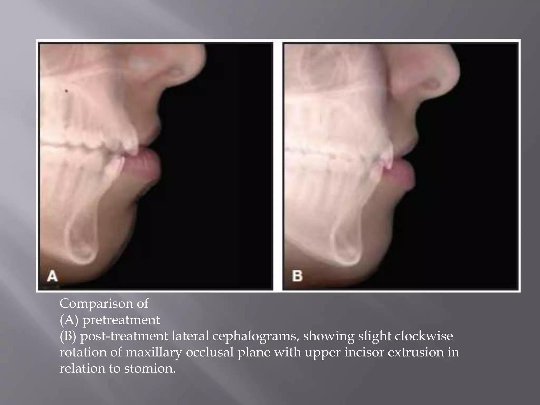 Comparison of
(A) pretreatment
(B) post-treatment lateral cephalograms, showing slight clockwise
rotation of maxillary occlusal plane with upper incisor extrusion in
relation to stomion.
 