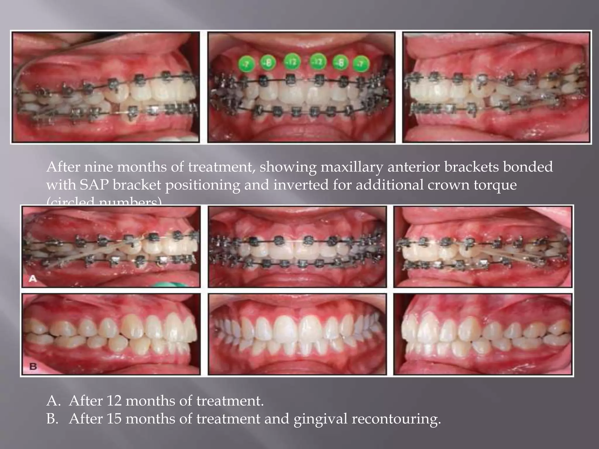 After nine months of treatment, showing maxillary anterior brackets bonded
with SAP bracket positioning and inverted for additional crown torque
(circled numbers).
A. After 12 months of treatment.
B. After 15 months of treatment and gingival recontouring.
 