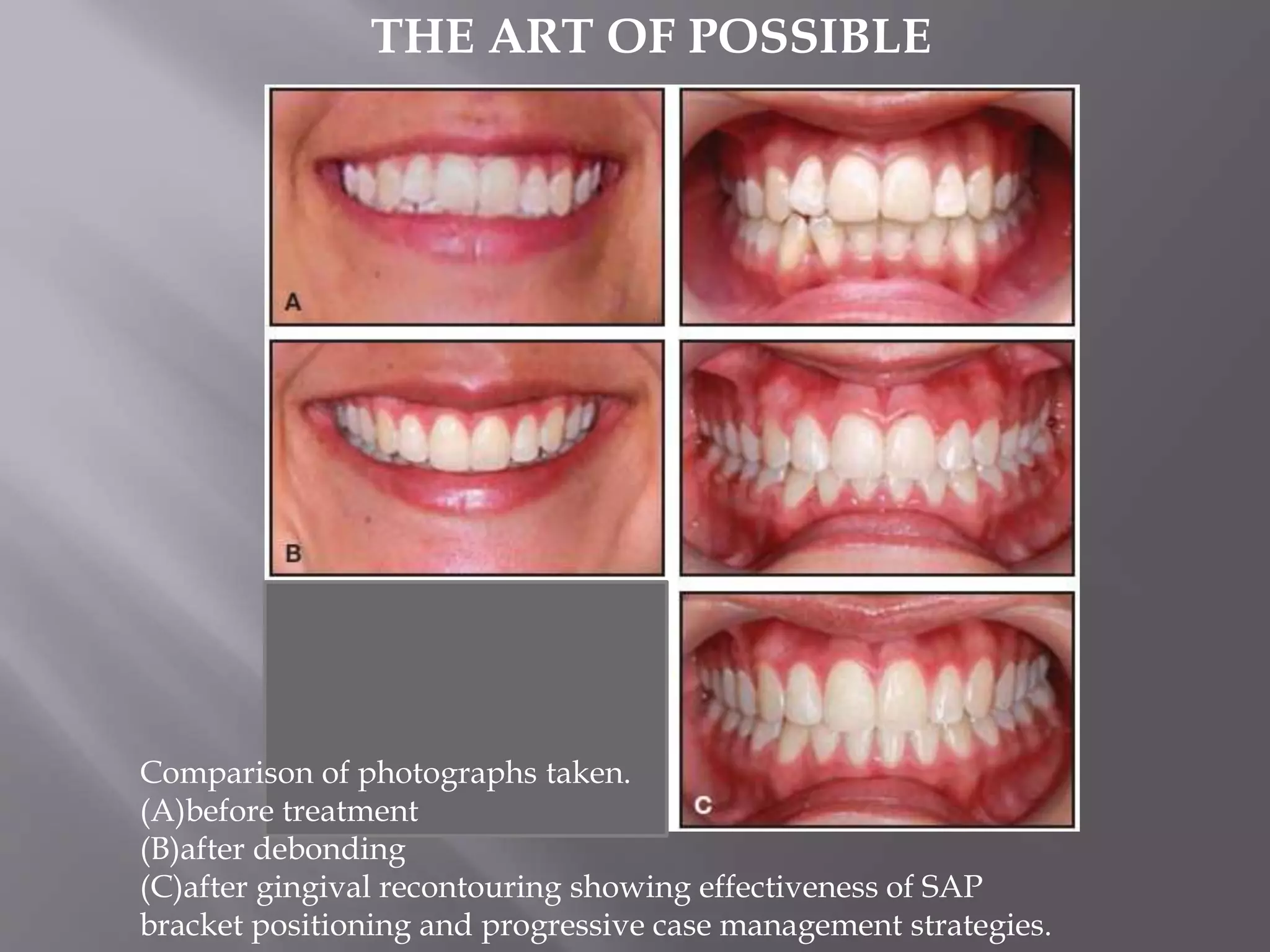 bracket positioning for smile arc protection | PPTX
