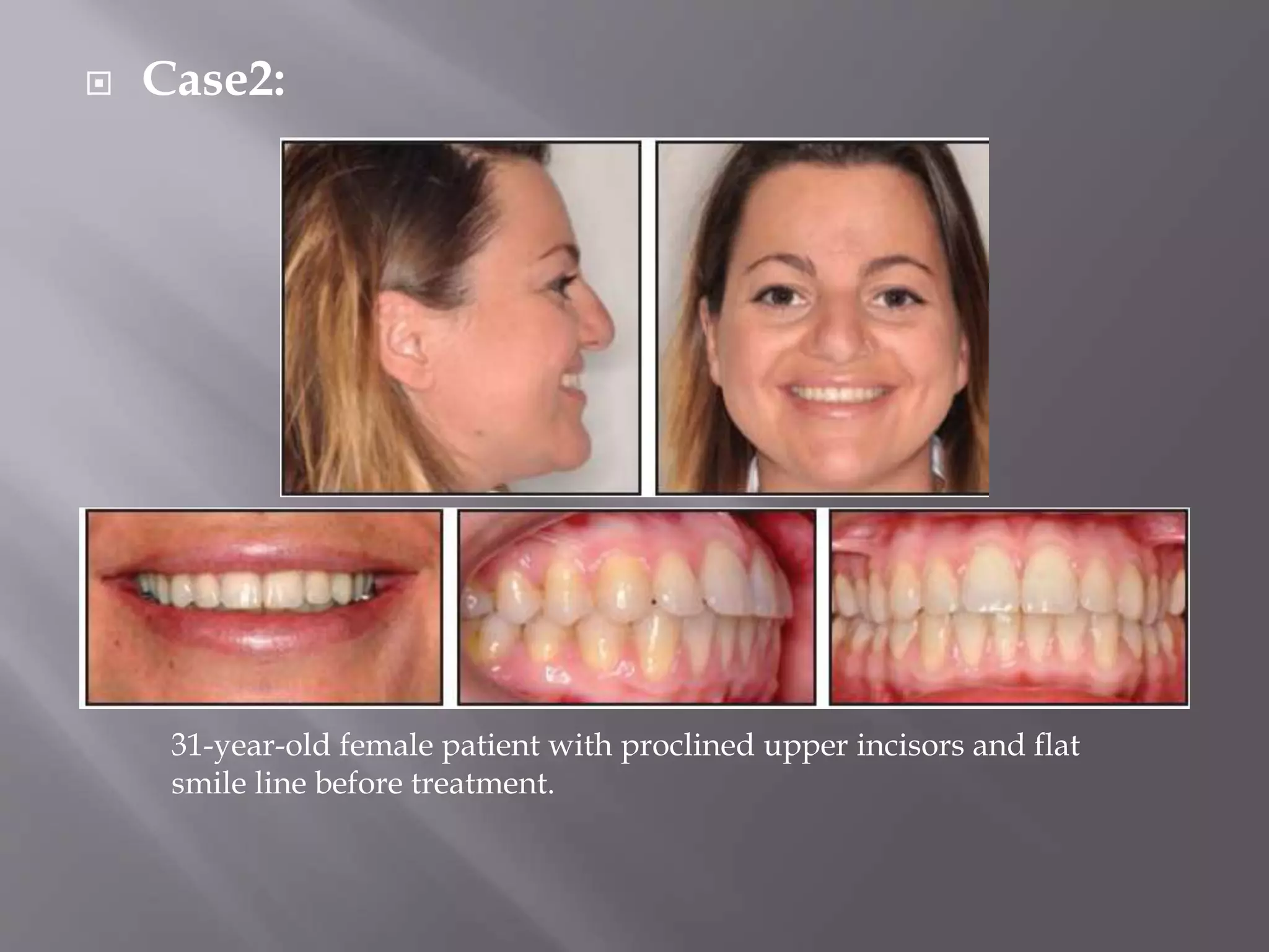  Case2:
31-year-old female patient with proclined upper incisors and flat
smile line before treatment.
 